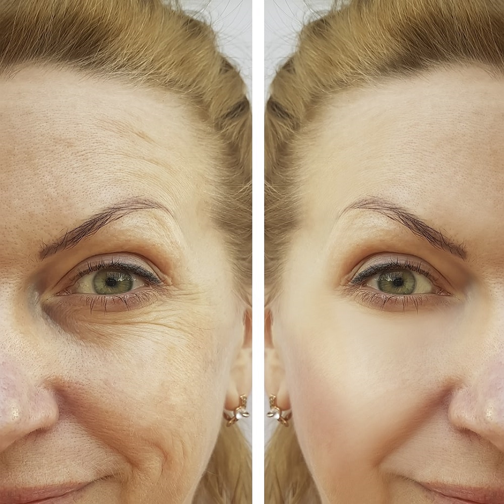 Омолаживающий филлер для кожи вокруг глаз: секреты и результаты